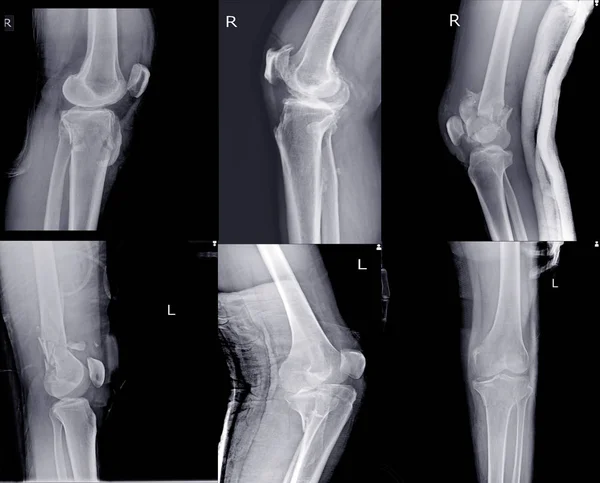 Kniegewricht x-ray collectie fractuur verschillende weergaven. Stockafbeelding