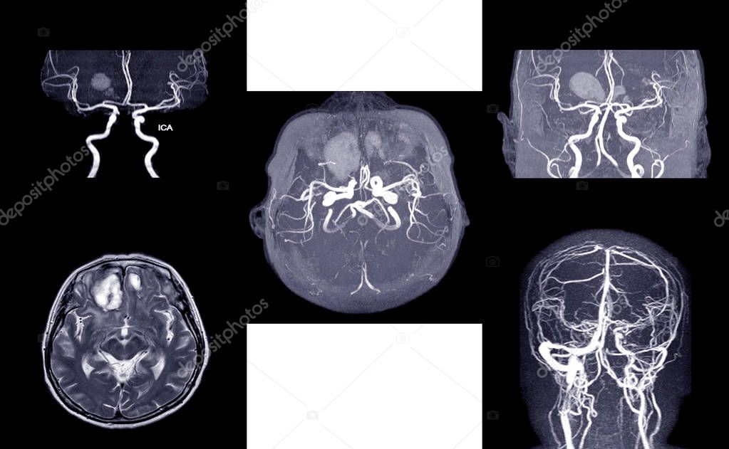 MRA AND MRV OF BRAIN:, presented with intracranial hemorrhage.