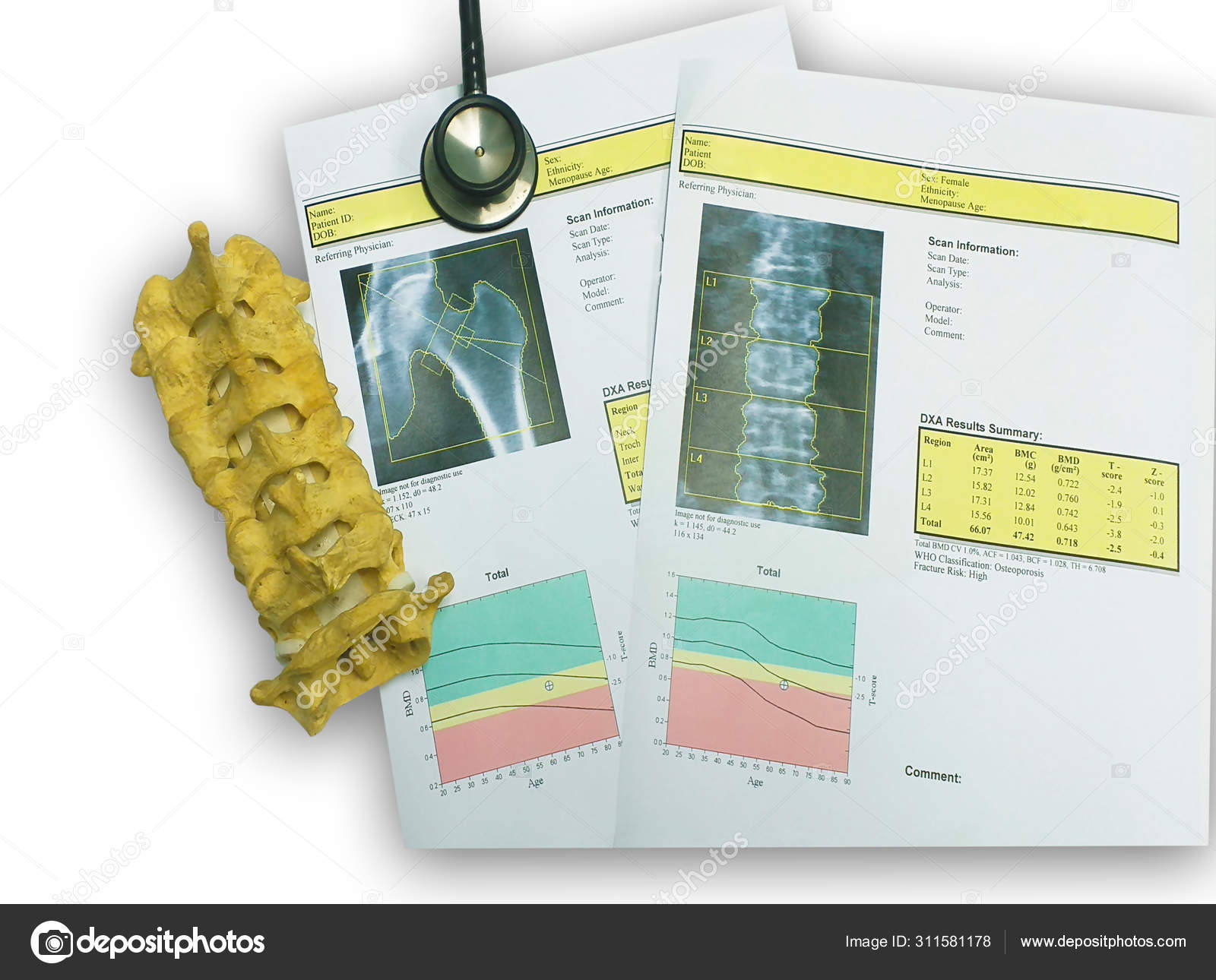 Bone density hip and lumbarspine Result Osteoporosis Stock Photo by