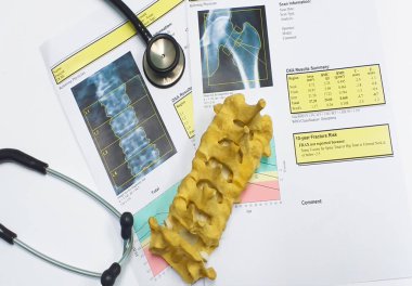 kemik yoğunluğu kalça ve lumbarvertebra sonuç osteoporoz