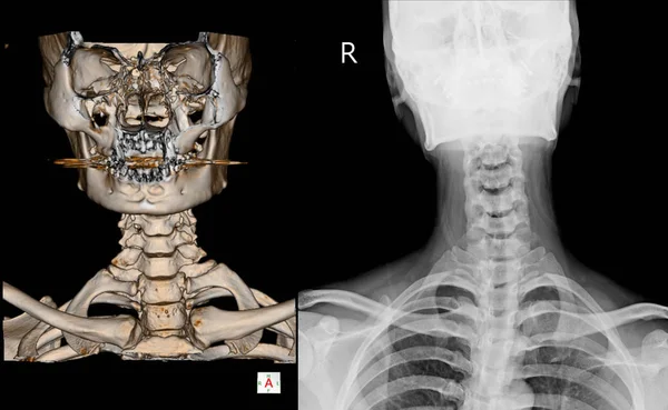 CT Scan cervical spine 3 D render and X-ray cervical spine. — Stock Photo, Image