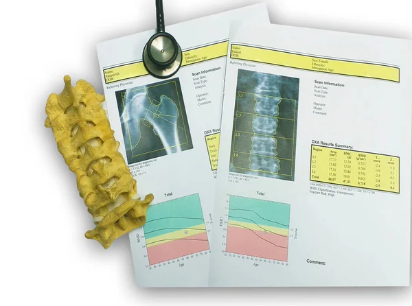Densidad ósea cadera y columna lumbar Resultado Osteoporosis — Foto de Stock