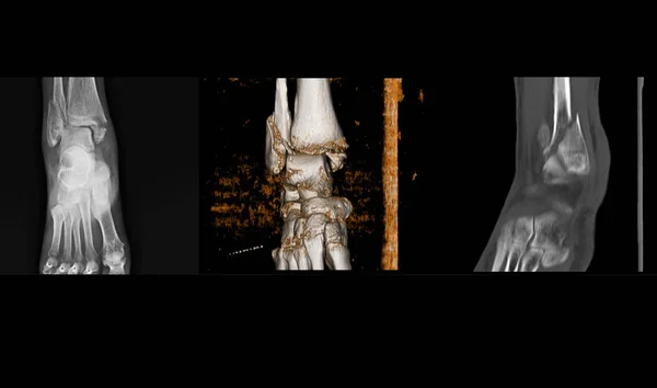 X-ray a Ct-scan rigth kotník ukazuje spirální zlomeniny distální — Stock fotografie