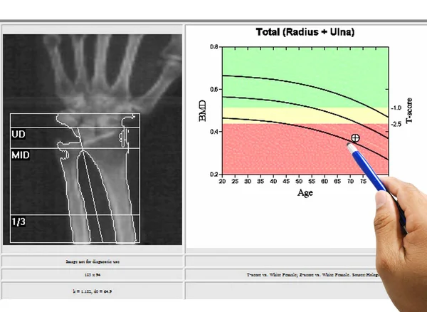 Examen spécial image médicale densité osseuse du poignet sur ba blanc — Photo
