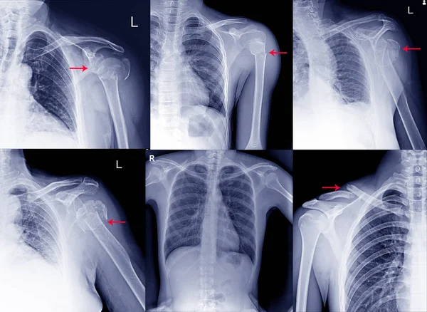 Gyűjtemény Film x ray váll röntgen mutatja váll ficam — Stock Fotó