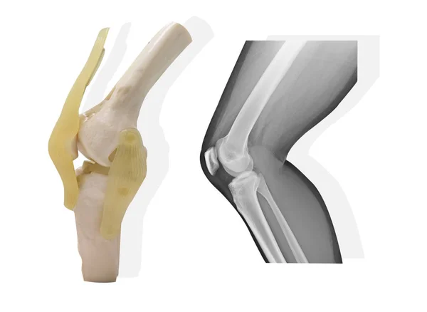 Kunstmatige Menselijke Knie Gewricht Model Met Medische Ray Knie Normaal — Stockfoto