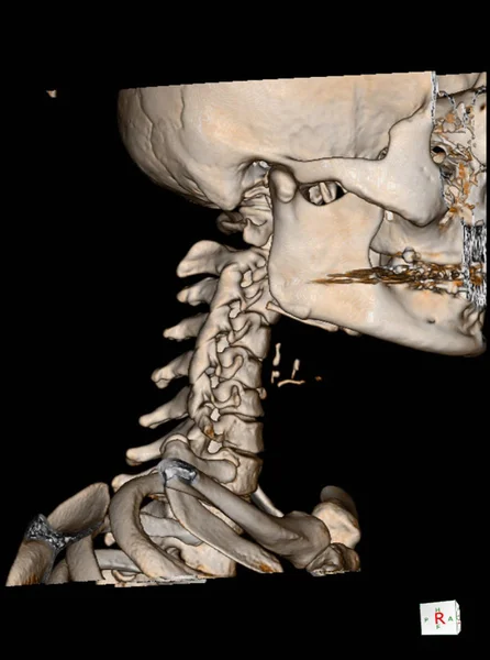 CT Scan cervical spine 3 D render . Stock Picture