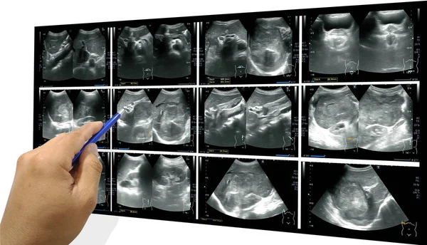 Ultrasound whole abdomen — Stock Image Ultrasound whole abdomen Stock Picture