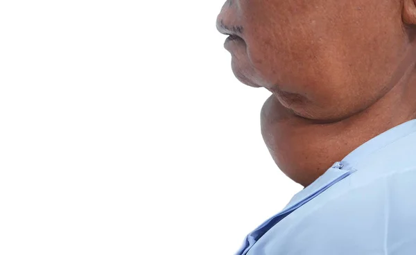 Old Asian female with very large thyroid gland. — Stock Photo, Image