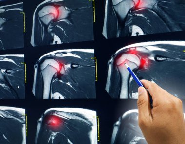 El doktoru omuz MR 'ı hastaya rotator manşet tendonu yırtılması, göz yaşartıcı, kırmızı odak noktasının sonucunu açıkla..