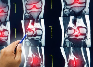 El doktorunun eline kalem alıp hastaya sağ dizinin MRI 'ını çekmesini açıkla..