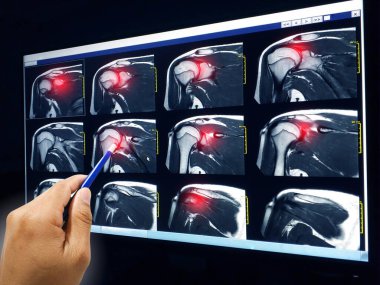 El doktoru omuz MR 'ı hastaya rotator manşet tendonu yırtılması, göz yaşartıcı, kırmızı odak noktasının sonucunu açıkla.