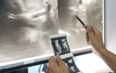 Yakın plan bulanıklaştırılmış el doktoru, ultrason sonrası ultrason görüntülerini sağlık kontrolü ve danışma sırasında inceler..