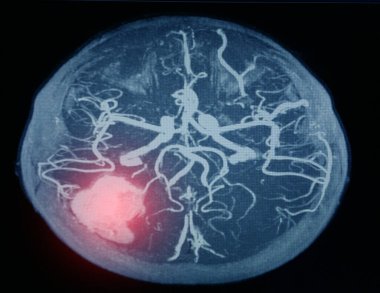 Beyin kanamasındaki serebral arterin MR ya da manyetik rezonans anjiyo görüntüsü (MRA).
