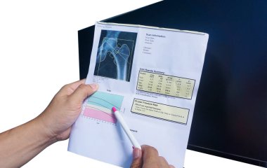 (DEXA densitometri kalça taraması. Osteoporia mevcut, beyaz arka plandaki kalem noktasında sıkça osteoporozun habercisi. Tıbbi sağlık konsepti..