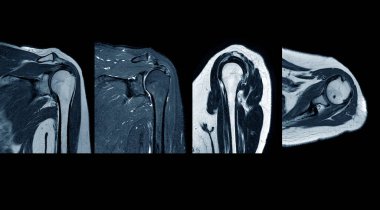 MRI Omuz Yırtılması geçmişi sol omuz lipomu şüphesiyle supraspinyatöz tendonun yırtılması. Tıbbi görüntü konsepti..