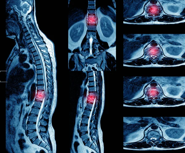 THORACIC Omurga MRI Bu bulgular TB spondilodiscitis 'in T11 / 12 seviyesinde apse oluşumu ve bilinçaltı yayılımına işaret ediyor..