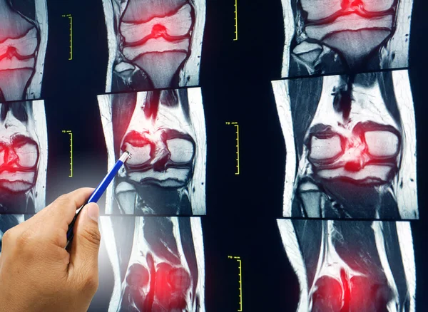 Acerque Médico Mano Sosteniendo Una Pluma Explique Los Resultados Del — Foto de Stock