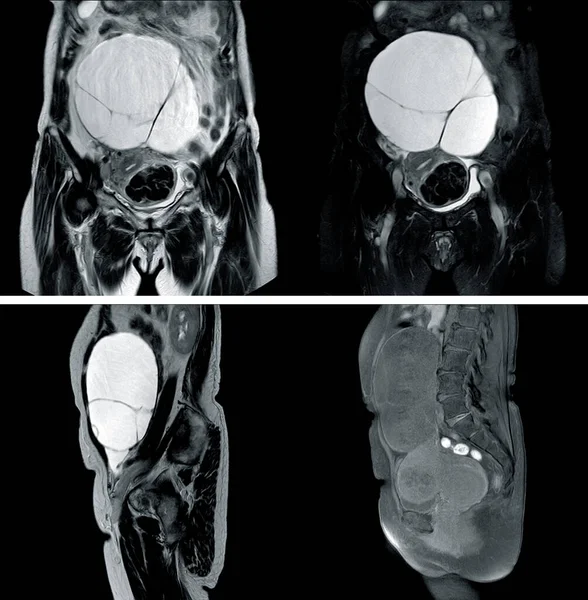 Mri Whole Abdomen History Kobieta Prezentowana Ogromnym Powikłanym Torbielowatym Uszkodzeniem — Zdjęcie stockowe