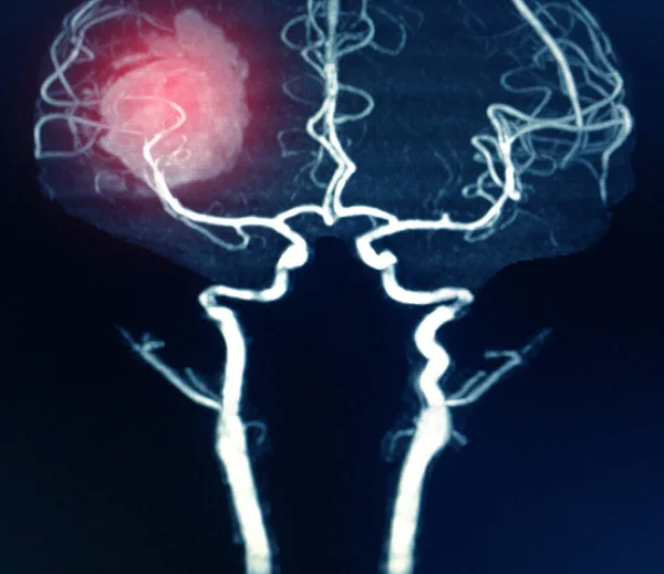 Mra Mozek Nebo Magnetická Rezonance Angiografie Obraz Mra Mozkové Tepny — Stock fotografie