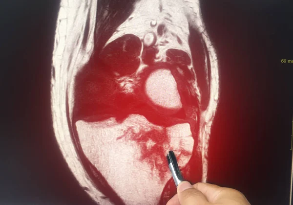 Close Doctor Held Pen Tell Mri Knee Result Patient Had — Stock Photo, Image