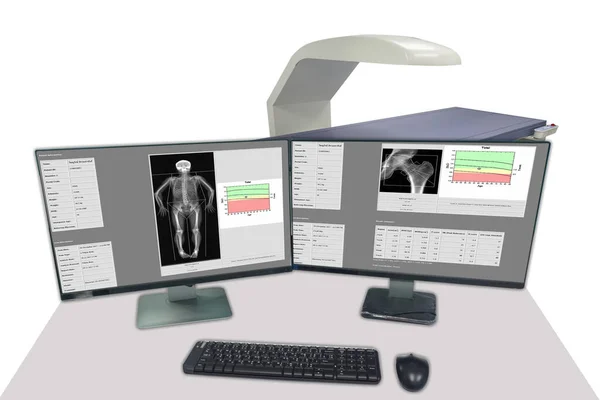 软硬而模糊的图像 液晶显示全身上下脊椎髋关节 骨质疏松症箭尖骨密度的特殊检查医学图像 — 图库照片