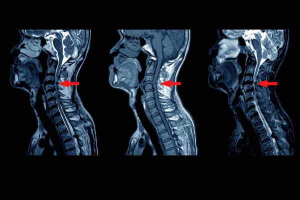 CERVICAL Omurga MRI: C3 / 4 ile C5 / 6 omurlar arası disklerin orta ve şiddetli arka disk çıkıntısı, 2.0 cm uzunluğunda, arka küçük sübligamentöz sıvı koleksiyonu. 