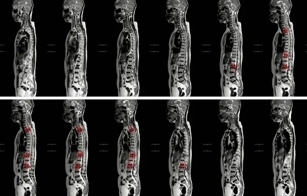 Mri Thoracolumbar Spine Impression Moderate Pathological Compression T11 Levels Enhancing — Stock Photo, Image