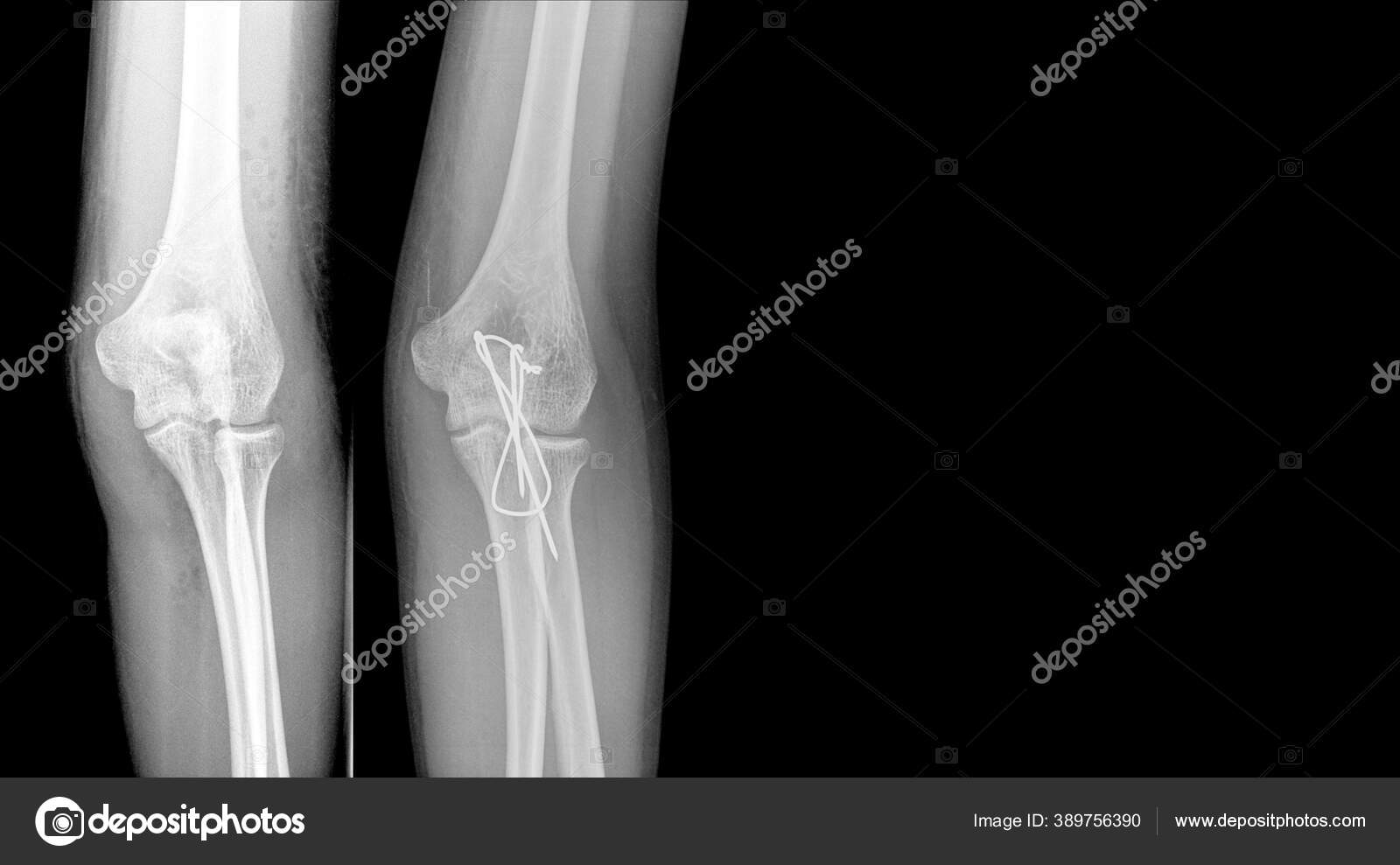 Cotovelo Raios Mostrando Fratura Fratura Proximal Ulna Olecranon Tratada  Por — Foto © Richmanphoto #389756390, image size:1600x989