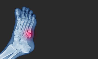Röntgen ayağında, duvardaki 5. parmak kemiği kırığı (metatarsal kırığın tabanı) görülüyor. Kırık bölge ve ağrının altını çiz. Tıbbi sağlık konsepti..