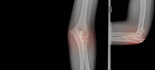 X线肘部显示骨折 近端Ulna或Olecranon骨折 采用张力带固定 Tbw 医疗仪器的重点 医疗保健概念 — 图库照片