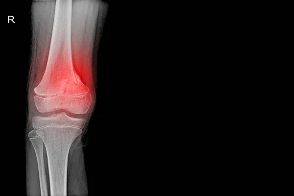 Diz Eklem Röntgeni Kırmızı Siyah Arka Planda Kırık Distal Femur — Stok fotoğraf