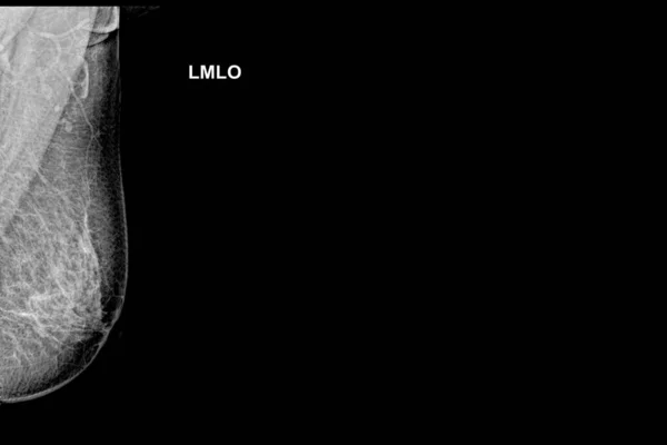 Spezielle Mammogrammaufnahme Cmediolateral Oblique Mlo Untersuchung Bei Frauen Über Jahren — Stockfoto