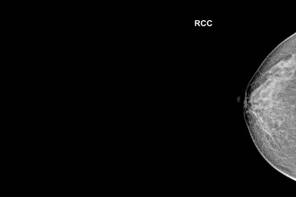 Spezielle Mammogrammaufnahme Craniocaudal View Untersuchung Bei Frauen Über Jahre Rechte — Stockfoto