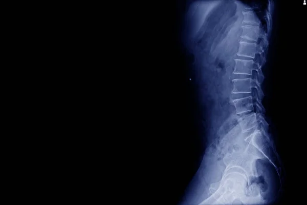 X线腰椎和骨盆无骨折 骨质疏松症发现无菌坏死的正常关节间隙 — 图库照片