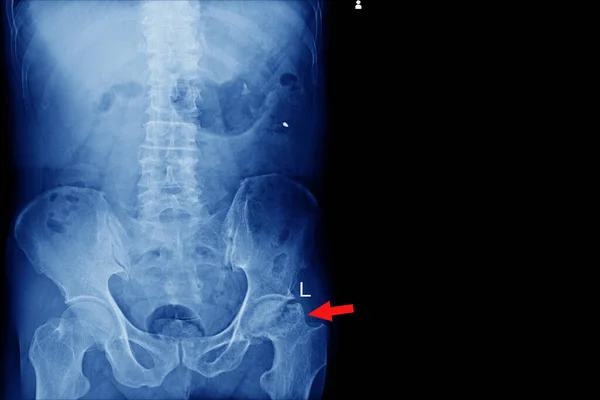 Radiografía Lumbo Sacra Espina Dorsal Pelvis Sin Fractura Dislocación Destrucción — Foto de Stock