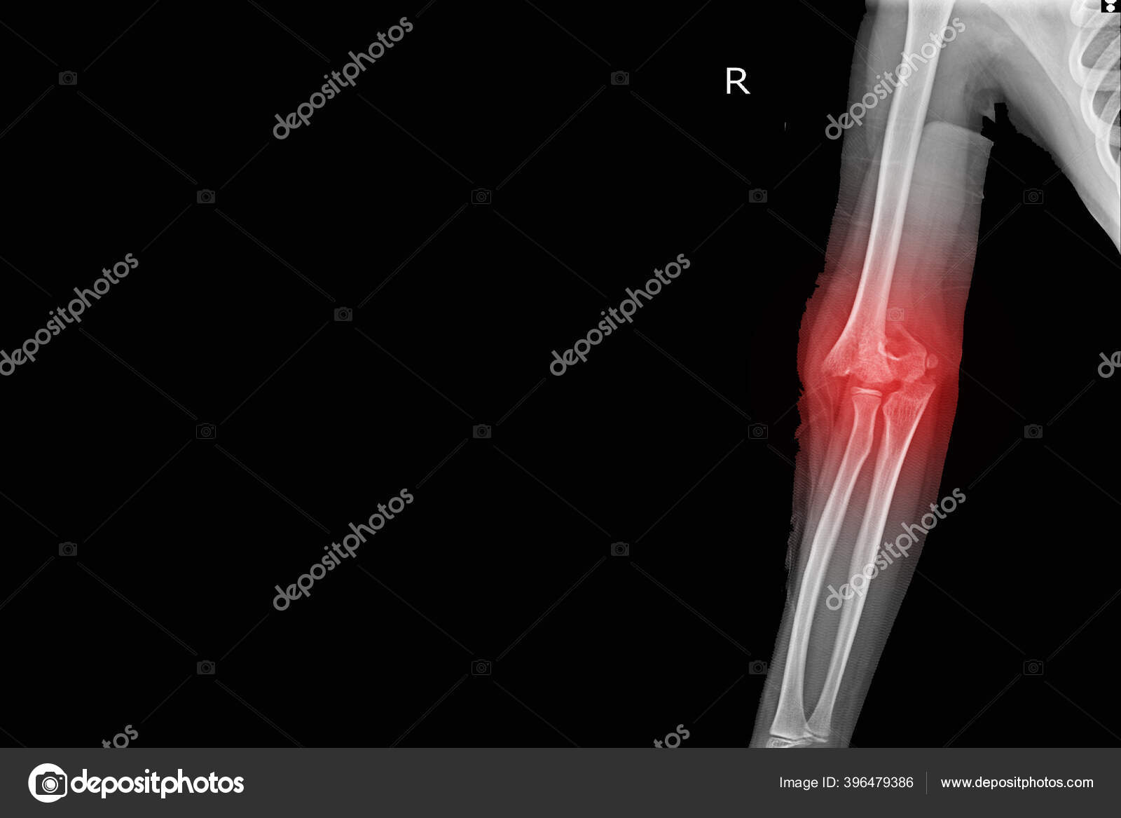 Raio Articulação Cotovelo Encontrar Fratura Supracondilar Úmero Distal Com  Derrame — Foto © Richmanphoto #396479386, image size:1600x1167
