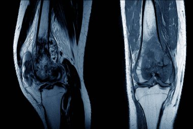 MRI Diz eklemi (AP, LATERAL) Osteosarkoma gösteren 15 yaşındaki bir kadını görüntüler..