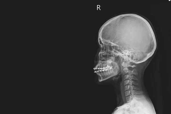 人間の子宮頸椎と頭の頭蓋骨のX線 セルラTurcicaは正常に見えます 医療画像の概念 — ストック写真