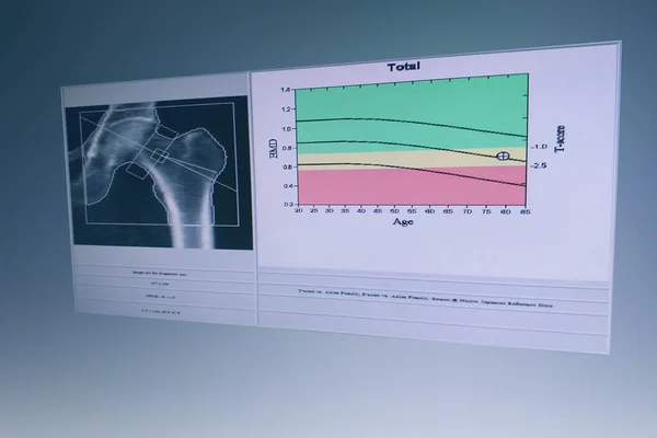 Bmd Imagen Masa Ósea Articulación Cadera Mujer Gráfico Tiene Punto — Foto de Stock