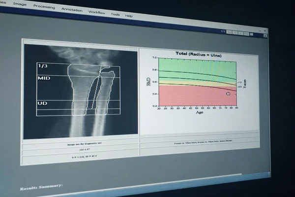 Puha Elmosódott Kép Női Csukló Teljes Sugár Singcsont Csonttömeg Kép — Stock Fotó