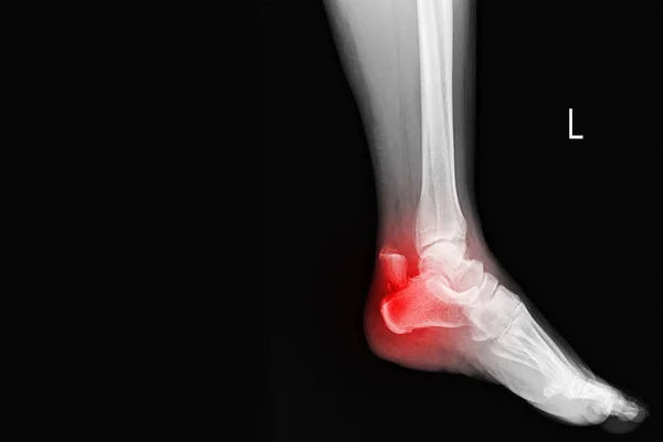 膜踝关节X射线摄像显示红斑 近端骨折跟骨 后跟骨骨折 医疗技术和保健概念 — 图库照片
