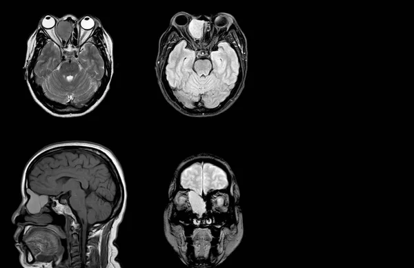 Mri Brain Orbit History Year Old Woman Presented Acute Headache — Stock Photo, Image