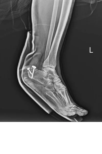 Radiografia Radiológica Tornozelo Mostrando Osso Calcanhar Quebrado Tratado Por Redução — Fotografia de Stock