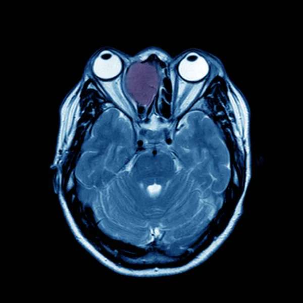 Mri Brain Orbitní Zjištění Studie Odhalila Dobře Ohraničené Expanzivní Růstové — Stock fotografie