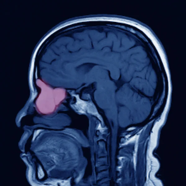 MRI OF BRAIN AND ORBIT FINDINGS :The study reveal a well-circumscribed, expansile growth lesion, occupying at right anterior ethmoid and right frontal sinuses.