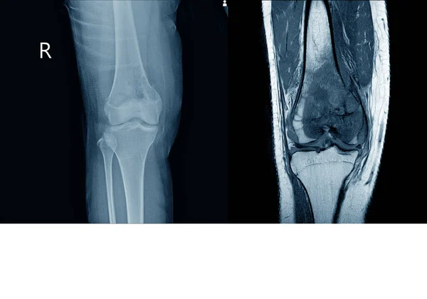 Rentgenowskie Mri Kolana Połączyć Pokazuje Duże Osteolityczne Lesuion Przyśrodkowego Aspektu — Zdjęcie stockowe