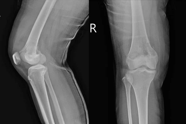 Rtg Stawu Kolanowego Lateral Widok Kobiety Wieku Lat Pokazuje Osteosarcoma — Zdjęcie stockowe