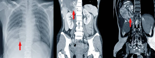 Radiografia Tomografia Computadorizada Ressonância Magnética Mostrando Massa Campo Pulmonar Inferior — Fotografia de Stock