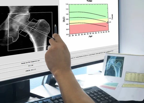 Weiches Und Verschwommenes Bild Handarzt Zeigt Das Bild Der Hüftknochenmasse — Stockfoto